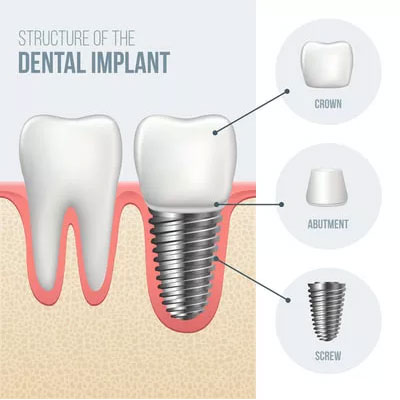 DENTAL IMPLANTS